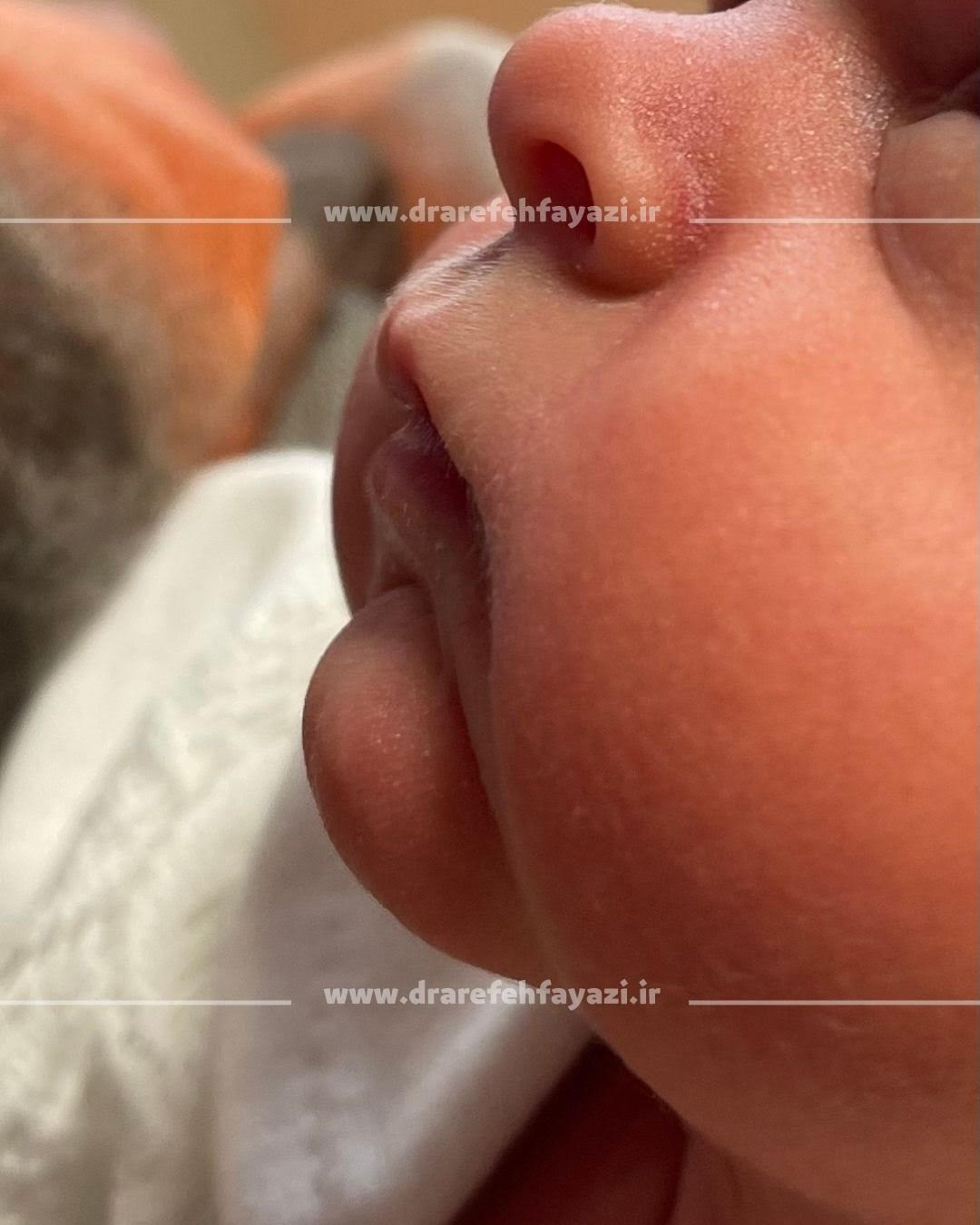 دردسرهای شیرین /نوزاد متولد شده از مادر مبتلا به دیابت 